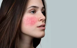 Couperose & rosacea